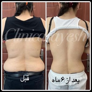 کرایولیپولیز برای لاغری