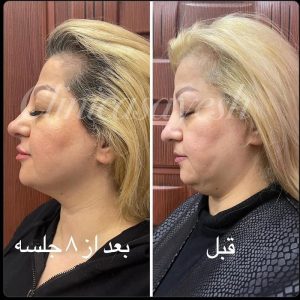 رفع و درمان غبغب با آر اف