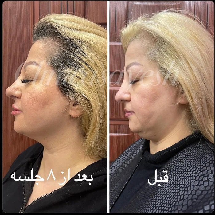 رفع و درمان غبغب با آر اف