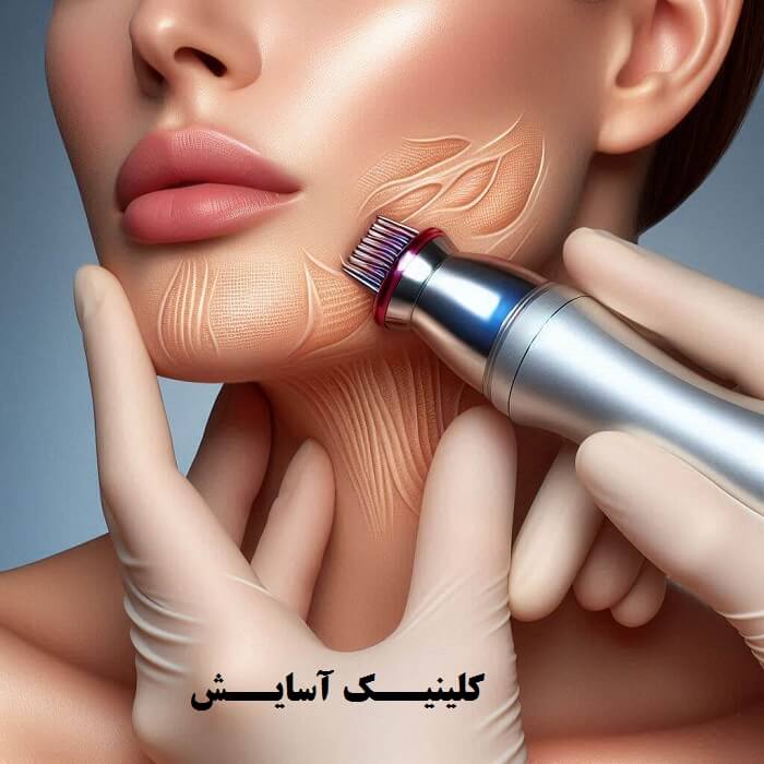 لیفت پوست با آر اف