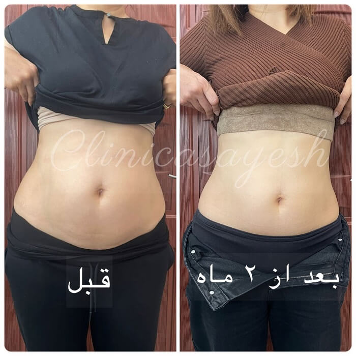 ویدیو لاغری شکم و پهلو با کرایولیپولیز