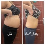 ویدیو لاغری شکم با کرایو لیپولیز
