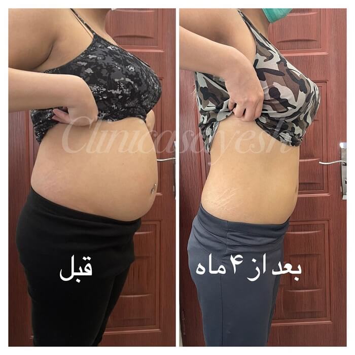 ویدیو لاغری شکم با کرایو لیپولیز