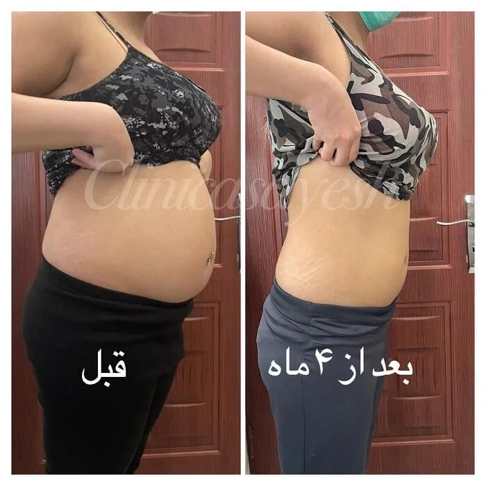 ویدیو لاغری شکم با کرایو لیپولیز