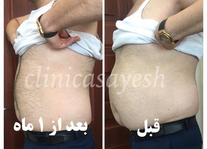 لاغری شکم با کرایولیپولیز