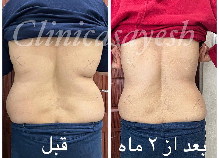 لاغری سوتین لاین با کرایولیپولیز