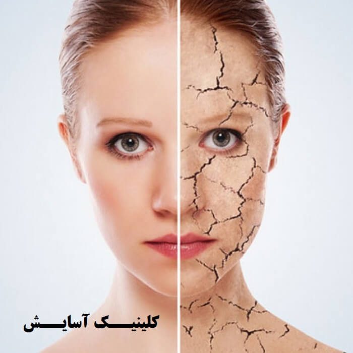 رفع و درمان ترک پوستی با آر اف