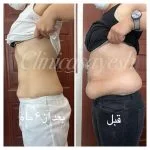 ویدیو لاعری پهلو با کرایولیپولیز