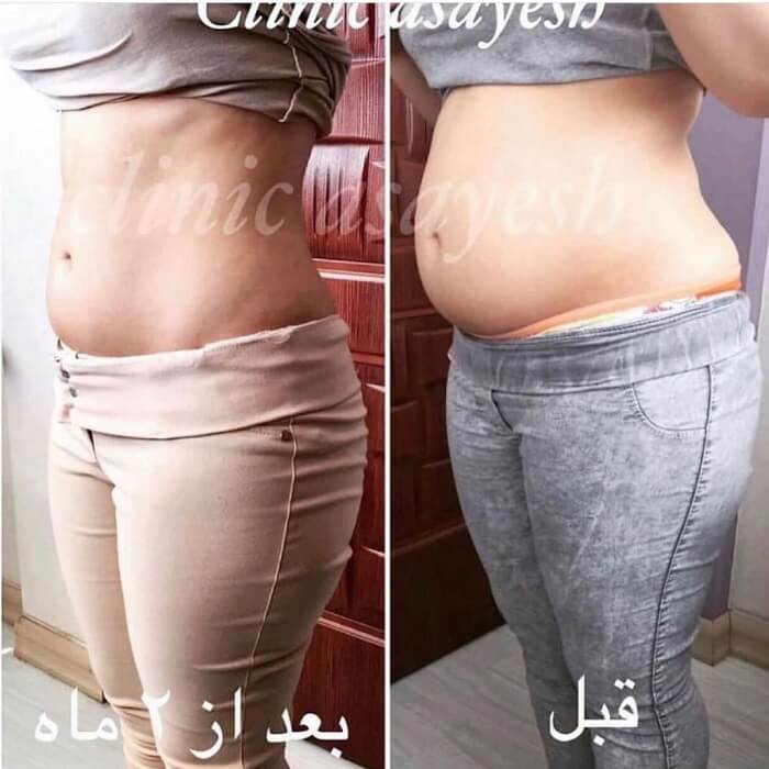 لاغری اندام مختلف با کرایولیپولیز